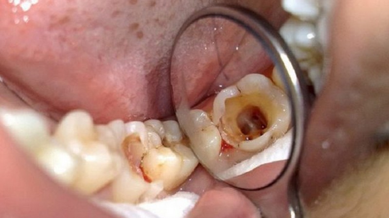 Mẹo Trị Đau Răng - Những biện pháp hiệu quả để giảm đau răng